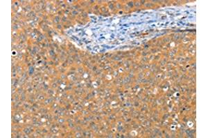 The image on the left is immunohistochemistry of paraffin-embedded Human cervical cancer tissue using ABIN7128218(ACY3 Antibody) at dilution 1/25, on the right is treated with fusion protein. (Aminoacylase 3 antibody)