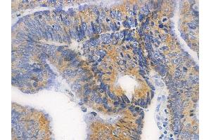 ABIN6256761 and ABIN6267621 at 1/100 staining human colon carcinoma by IHC-P.