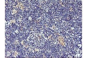 Immunohistochemical staining of paraffin-embedded Human lymphoma tissue using anti-DPP9 mouse monoclonal antibody. (DPP9 antibody)