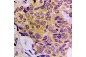 Immunohistochemical analysis of CDK5RAP3 staining in human breast cancer formalin fixed paraffin embedded tissue section. (CDK5RAP3 antibody  (Center))
