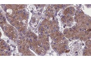 ABIN6272759 at 1/100 staining Human liver cancer tissue by IHC-P. (OR52K2 antibody)
