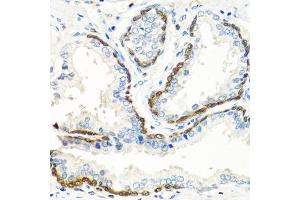 Immunohistochemistry of paraffin-embedded human prostate using BMP5 antibody. (BMP5 antibody)