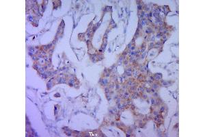 Paraformaldehyde-fixed, paraffin embedded human cervical cancer, Antigen retrieval by boiling in sodium citrate buffer (pH6. (MUC16 antibody  (AA 250-350))
