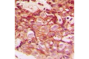 Immunohistochemical analysis of CLIP3 staining in human breast cancer formalin fixed paraffin embedded tissue section. (CLIP3 antibody)