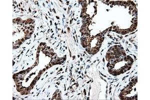 Immunohistochemical staining of paraffin-embedded Adenocarcinoma of ovary tissue using anti-PSMC3 mouse monoclonal antibody. (PSMC3 antibody)