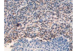 IHC-P analysis of Human Skin Cancer Tissue, with DAB staining. (GRK2 antibody  (AA 398-640))