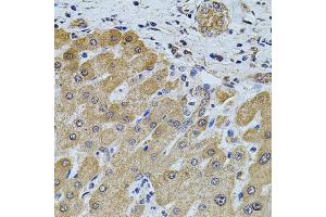 Immunohistochemistry of paraffin-embedded human liver injury using FOXO3 antibody (ABIN2736768) at dilution of 1:100 (40x lens). (FOXO3 antibody)