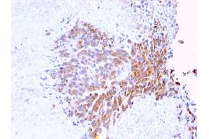 Formalin-fixed, paraffin-embedded human Melanoma stained with Topo I, MT Mouse Monoclonal Antibody (TOP1MT/568) (TOP1MT antibody)