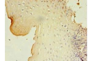 Immunohistochemistry of paraffin-embedded human cervical cancer using ABIN7153277 at dilution of 1:100 (GKAP1 antibody  (AA 21-366))