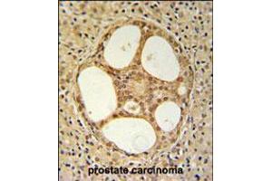 PRUNE Antibody IHC analysis in formalin fixed and paraffin embedded prostate carcinoma followed by peroxidase conjugation of the secondary antibody and DAB staining. (PRUNE antibody  (C-Term))