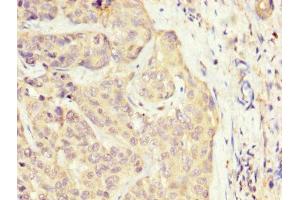IHC image of ABIN7170156 diluted at 1:300 and staining in paraffin-embedded human liver cancer performed on a Leica BondTM system. (SLC22A25 antibody  (AA 31-145))