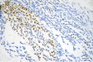 Immunohistochemistry was performed on paraffin-embedded human sigmoid colon carcinoma using DUT antibody (ABIN7798312), 1:200).