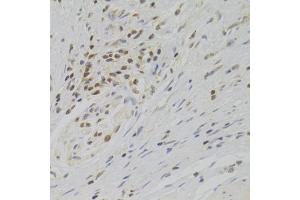 Immunohistochemistry of paraffin-embedded human gastric cancer using TAF1C Antibody (ABIN2560282) at dilution of 1:100 (40x lens). (TAF1C antibody)
