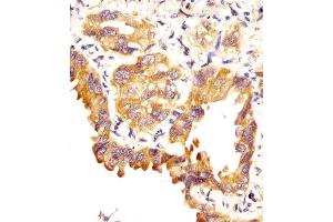 (ABIN657607 and ABIN2846604) staining SFTPC in human lung adenocarcinoma sections by Immunohistochemistry (IHC-P - paraformaldehyde-fixed, paraffin-embedded sections). (Surfactant Protein C antibody  (C-Term))