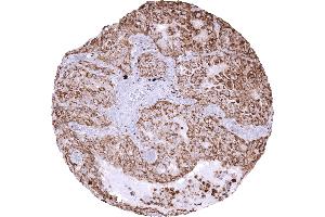 Adenocarcinoma of the lung with strong expression of Napsin A (Recombinant NAPSA antibody  (AA 189-299))