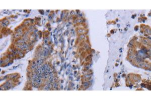 Immunohistochemistry of paraffin-embedded Human esophagus cancer tissue using MT3 Polyclonal Antibody at dilution 1:50 (MT3 antibody)