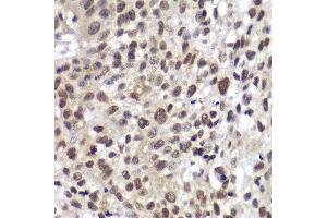 Immunohistochemistry of paraffin-embedded human lung cancer using CHEK2 antibody at dilution of 1:100 (400x lens). (CHEK2 antibody)