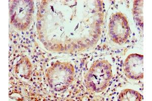 Immunohistochemistry of paraffin-embedded human colon cancer using ABIN7176599 at dilution of 1:100 (TRIM27 antibody  (AA 214-513))