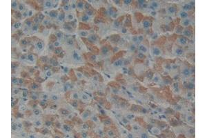 Detection of EDN1 in Human Liver cancer Tissue using Polyclonal Antibody to Endothelin 1 (EDN1) (Endothelin 1 antibody  (AA 53-90))