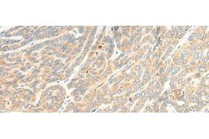 Immunohistochemistry of paraffin-embedded Human liver cancer tissue using TTC4 Polyclonal Antibody at dilution of 1:45(x200) (TTC4 antibody)