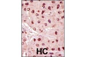 Formalin-fixed and paraffin-embedded human cancer tissue reacted with the primary antibody, which was peroxidase-conjugated to the secondary antibody, followed by DAB staining. (MEK1 antibody  (N-Term))