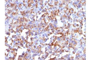 Formalin-fixed, paraffin-embedded human Histiocytoma stained with CD68 Mouse Monoclonal Antibody (LAMP4/824). (CD68 antibody)