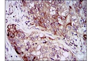 Immunohistochemical analysis of paraffin-embedded lung cancer tissues using HSP90AA1 mouse mAb with DAB staining. (HSP90AA1 antibody)