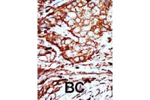 Formalin-fixed and paraffin-embedded human breast cancer tissue reacted with YWHAB polyclonal antibody  , which was peroxidase-conjugated to the secondary antibody, followed by AEC staining. (YWHAB antibody  (C-Term))