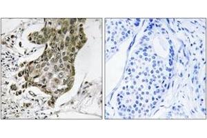 Immunohistochemistry analysis of paraffin-embedded human breast carcinoma tissue, using RABEP1 Antibody. (RABEP1 antibody  (AA 549-598))