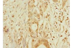 Immunohistochemistry of paraffin-embedded human pancreatic cancer using ABIN7160425 at dilution of 1:100 (MPZL2 antibody  (AA 30-140))