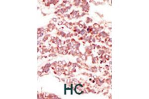Immunohistochemistry (IHC) image for anti-PTK7 Protein tyrosine Kinase 7 (PTK7) antibody (ABIN3003499)