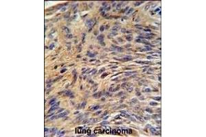 HS Antibody (Center) (ABIN651232 and ABIN2840144) IHC analysis in formalin fixed and paraffin embedded human lung carcinoma followed by peroxidase conjugation of the secondary antibody and DAB staining. (GRP78 antibody  (AA 261-289))