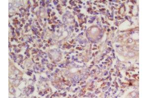 Formalin-fixed and paraffin embedded human laryngeal carcinoma labeled with Rabbit Anti-Cyclin E Polyclonal Antibody, Unconjugated (ABIN670311) at 1:200 followed by conjugation to the secondary antibody and DAB staining (Cyclin E1 antibody  (AA 375-411))
