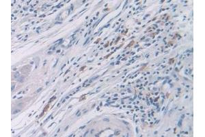 Detection of CDK2 in Human Colorectal cancer Tissue using Polyclonal Antibody to Cyclin Dependent Kinase 2 (CDK2) (CDK2 antibody  (AA 94-198))