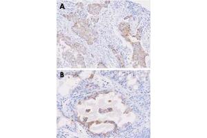 Paraffin embedded sections of human breast cancer (A) and prostate hyperplasia tissue (B) were incubated with STEAP1 monoclonal antibody, clone J2D2  (1 : 50) for 2 hours at room temperature. (STEAP1 antibody  (AA 1-70))