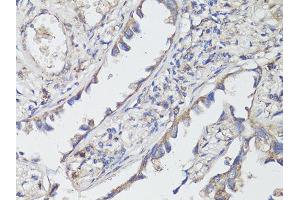 Immunohistochemistry of paraffin-embedded human lung cancer using NTRK2 antibody (ABIN6290695) at dilution of 1:200 (40x lens). (TRKB antibody)