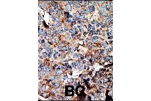 Formalin-fixed and paraffin-embedded human cancer tissue reacted with the primary antibody, which was peroxidase-conjugated to the secondary antibody, followed by AEC staining. (NME2 antibody  (N-Term))