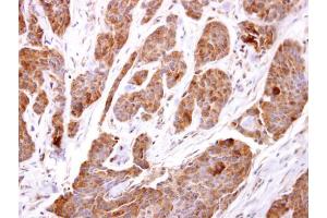 IHC-P Image TBCC antibody [N1C3] detects TBCC protein at cytosol on human breast carcinoma by immunohistochemical analysis. (TBCC antibody)