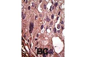 Formalin-fixed and paraffin-embedded human cancer tissue reacted with the primary antibody, which was peroxidase-conjugated to the secondary antibody, followed by DAB staining. (FNTB antibody  (N-Term))