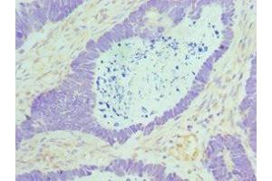 Immunohistochemistry of paraffin-embedded human ovarian cancer using ABIN7160088 at dilution of 1:100 (MAD2L1 antibody  (AA 1-205))