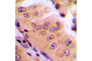 Immunohistochemical analysis of MGCRACGAP staining in human lung cancer formalin fixed paraffin embedded tissue section. (RACGAP1 antibody)