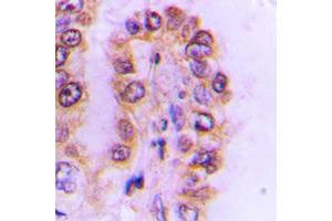 Immunohistochemical analysis of Cytochrome P450 4F2 staining in human liver cancer formalin fixed paraffin embedded tissue section. (CYP4F2 antibody  (N-Term))