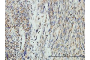 Immunoperoxidase of monoclonal antibody to DNM1L on formalin-fixed paraffin-embedded human leiomyosarcoma tissue. (Dynamin 1-Like antibody  (AA 1-710))