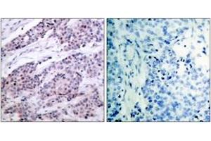 Immunohistochemistry analysis of paraffin-embedded human breast carcinoma tissue, using BCL-2 (Ab-56) Antibody. (Bcl-2 antibody  (AA 26-75))
