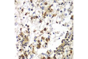 Immunohistochemistry of paraffin-embedded human kidney cancer using SND1 antibody (ABIN5973481) at dilution of 1/100 (40x lens). (SND1 antibody)