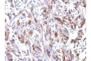 IHC-P Image Immunohistochemical analysis of paraffin-embedded U251 xenograft, using alpha Tubulin, antibody at 1:500 dilution. (TUBA1B antibody)