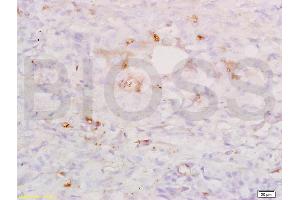 Formalin-fixed and paraffin embedded human lung carcinoma labeled with Anti-SP-D/PSPD Polyclonal Antibody, Unconjugated (ABIN731678) at 1:200, followed by conjugation to the secondary antibody and DAB staining.