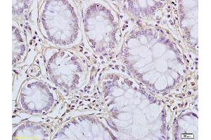 Formalin-fixed and paraffin embedded human colon carcinoma labeled with Anti-FUS Polyclonal Antibody, Unconjugated (ABIN682438) at 1:200 followed by conjugation to the secondary antibody and DAB staining (FUS antibody  (AA 421-526))