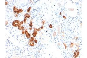 Formalin-fixed, paraffin-embedded human Kidney stained with Calbindin 1 Mouse Monoclonal Antibody (CALB1/2782). (CALB1 antibody  (AA 7-96))