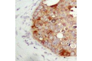 Immunohistochemical analysis of FAP alpha staining in human prostate cancer formalin fixed paraffin embedded tissue section. (FAP antibody)